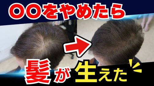 【頭皮ケア】女性の薄毛対策に1番重要ポイントとは!?