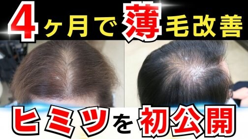 【4ヶ月で薄毛対策】女性の改善事例900以上のヒミツを大公開