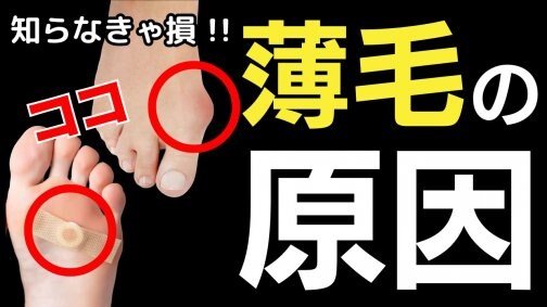 【薄毛の原因は足裏だった!?】女性の薄毛リスクを外反母趾と魚の目が高める根拠