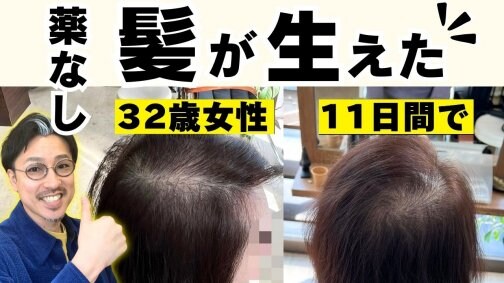 30代女性が11日後に薄毛改善を実感した方法3選