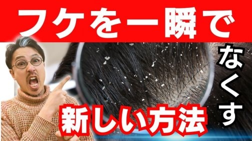 【フケを一瞬でなくす】対策とアイテムの紹介