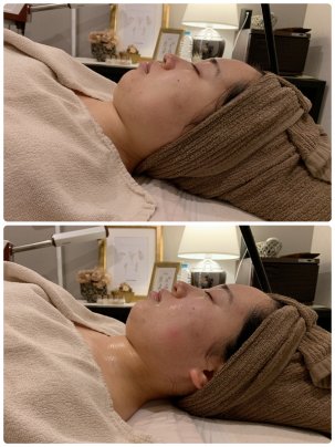 小顔ボンバーフェイシャル