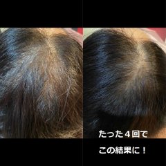初回体験☆【育毛促進】幹細胞上清液を使用した最新美容