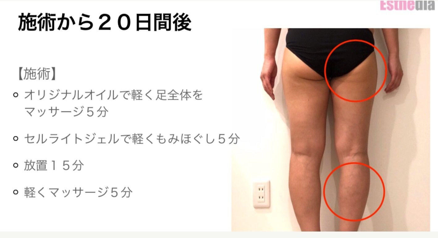 セルライト分解ダイエット