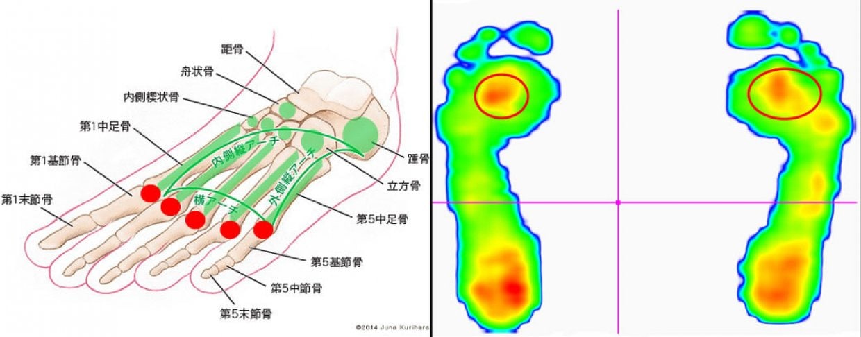 アーチを解放したCISRR（しーさー）は足底筋の機能を発揮させる目的のインソールです。