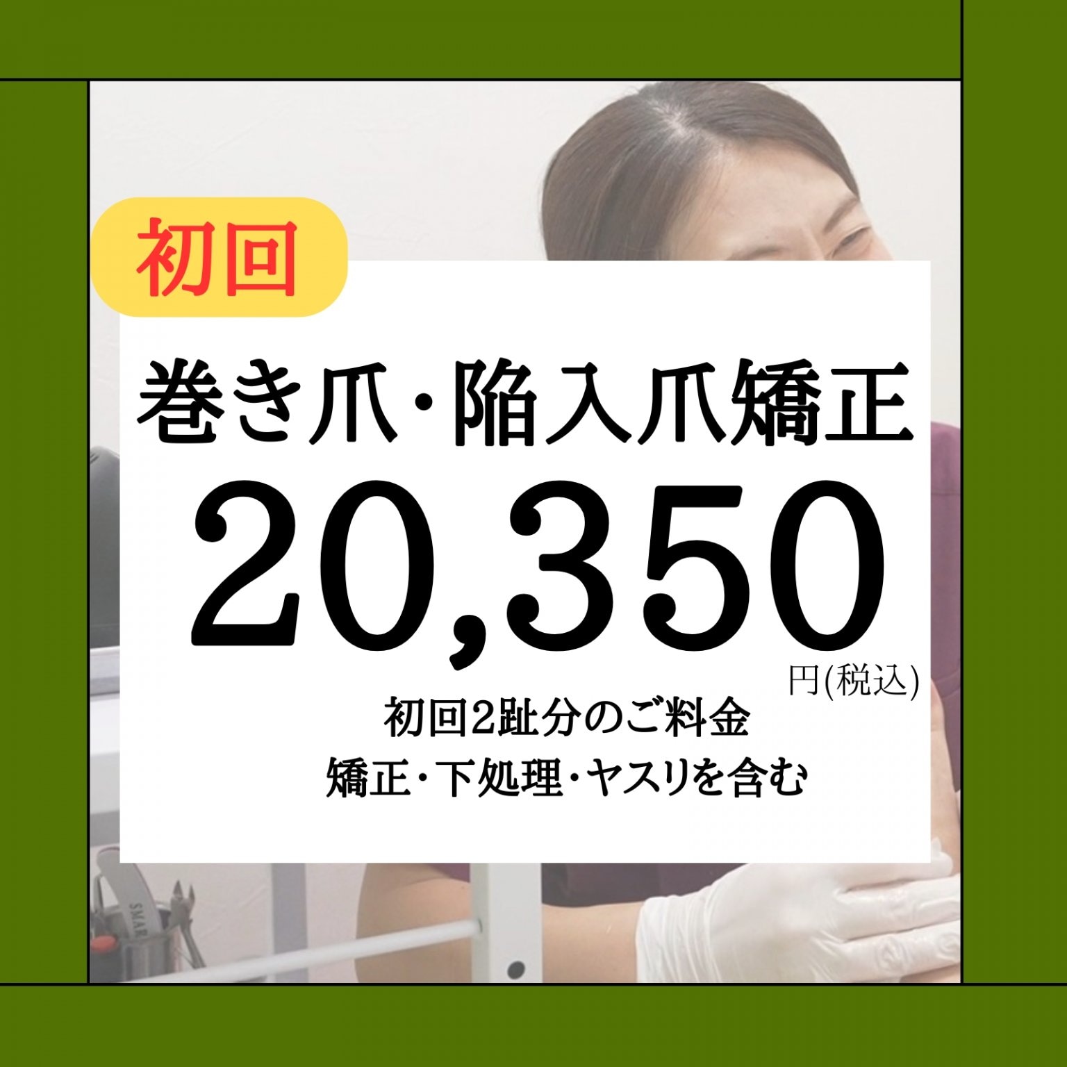 巻き爪矯正施術2趾両側初回限定セット