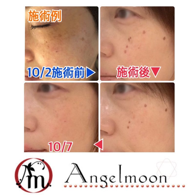 シミみんサロンしみデトックス体験コース キレイと元気になれる エンジェルムーン ツクツク ウェブチケット モバイル コトの通販サイト 体験を買える