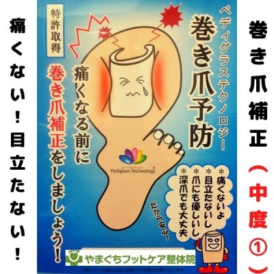 痛くない！！巻き爪補正（中度①）