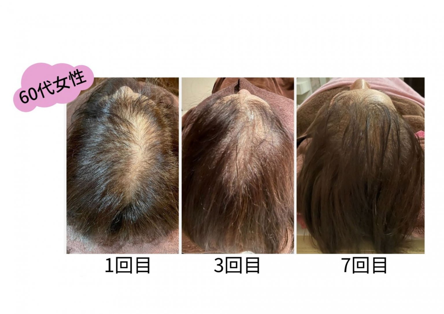 【初回限定】グロウヘアスパ