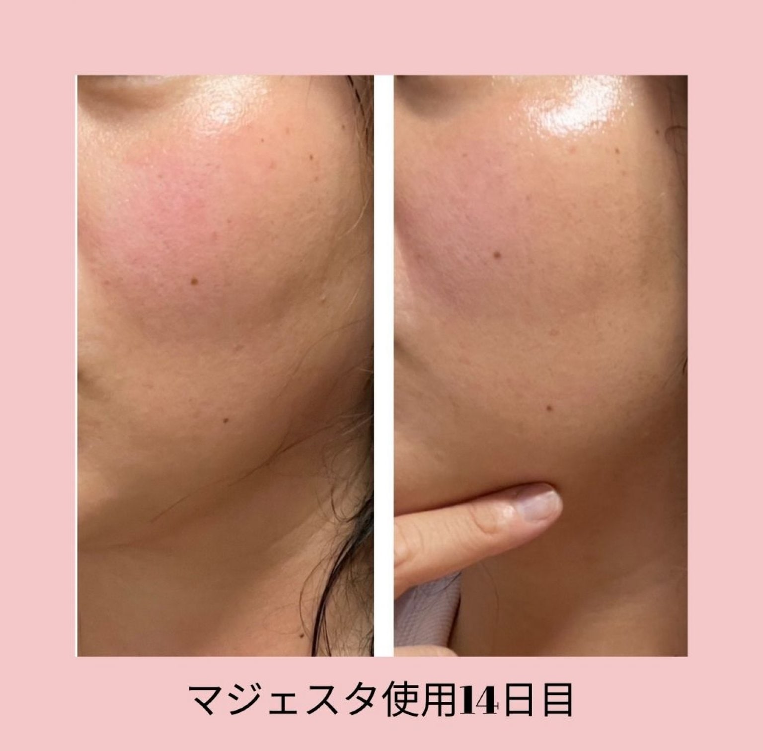 私決めた　たった28日間で自慢の素肌になる　美肌体験モニターオンラインMJコース