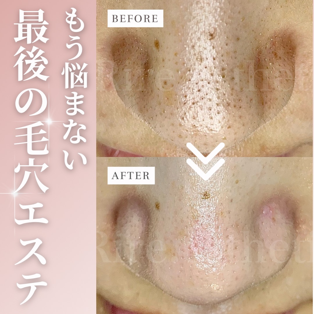 人気No.1毛穴改善コース - 八王子エステ | Rire.esthetic-リールエステ