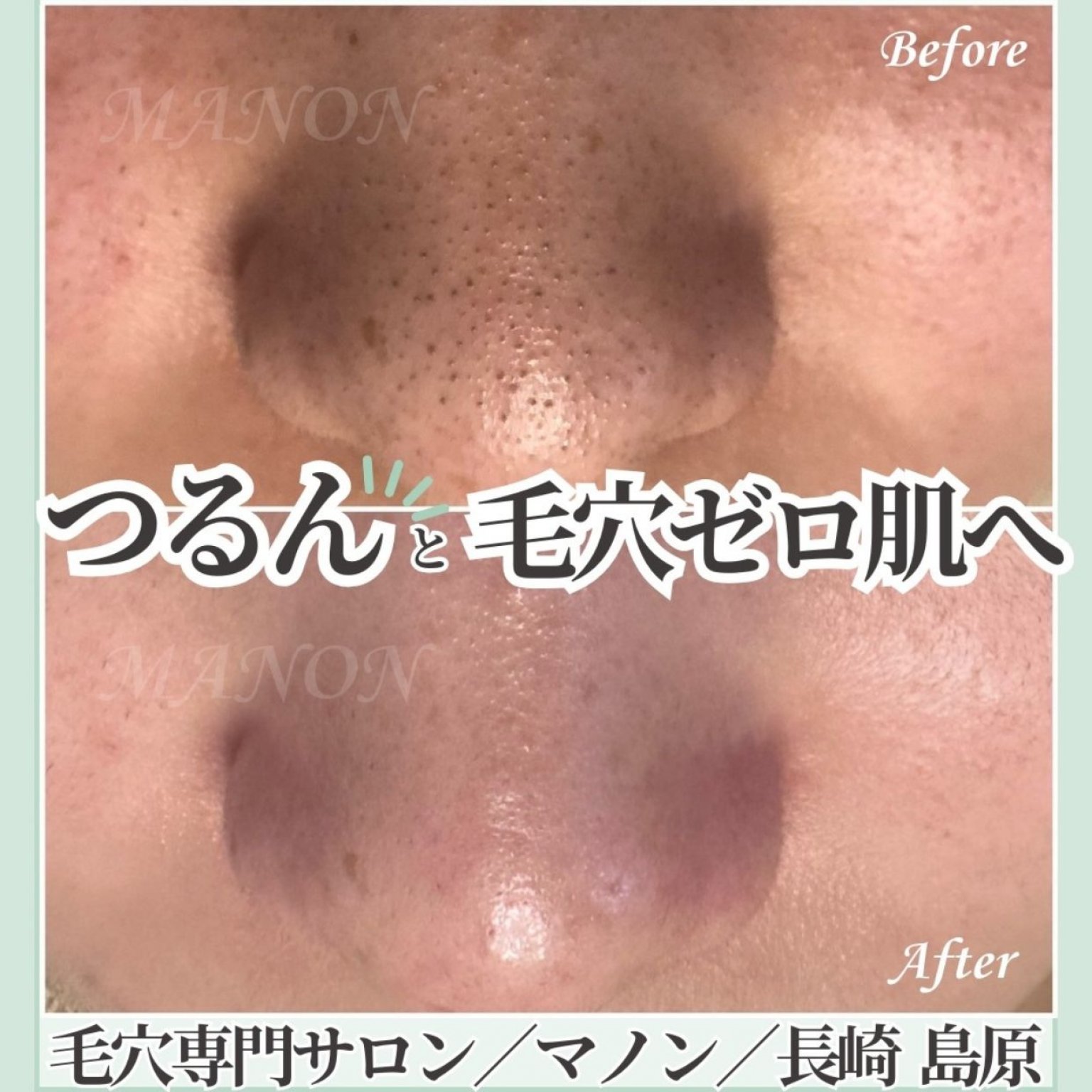 毛穴エステ 込900円 人気No.1毛穴改善コース - 八王子エステ | Rire